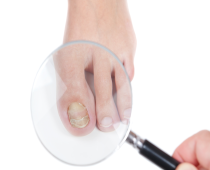 Nail Diseases Rangwala Clinic Mumbai