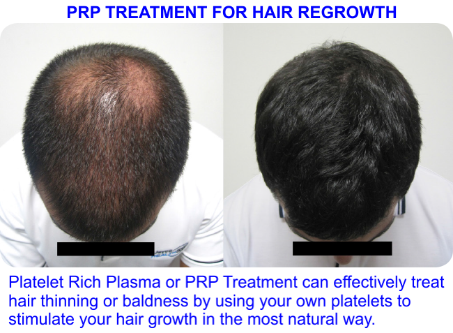 Platelet rich plasma for Hair growth